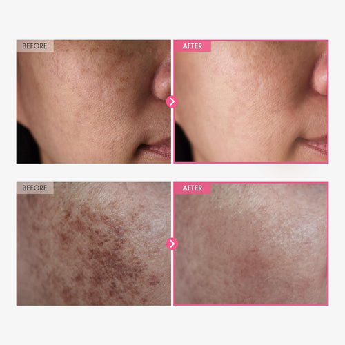 Binna 빛나 7% Arbutin + 4% Tranexamic Acid